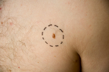 Skin Cancer - Removal Incision Outline