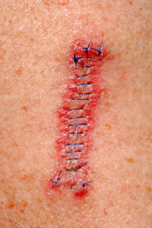 Skin Cancer - Stitches After Removal
